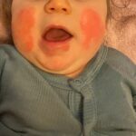 Vauvan punaiset posket viivästyneen allergisen reaktion aikana