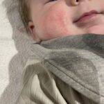 Ruoka-aineallergian aiheuttama poskien atooppinen ihottuma